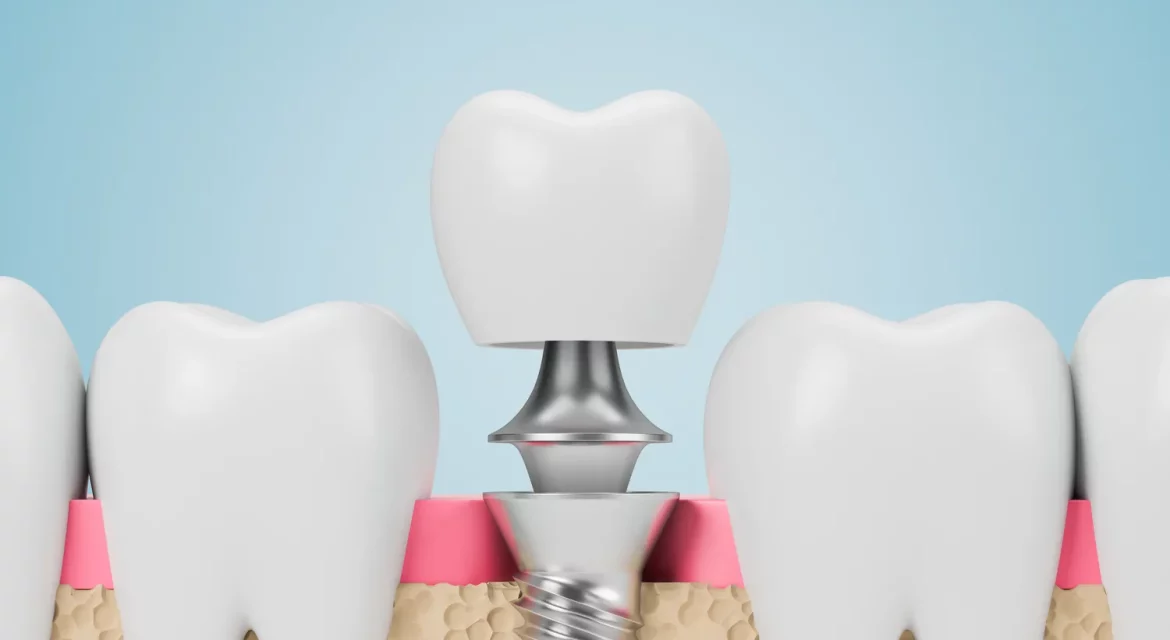 Dentysta Szczecin implanty